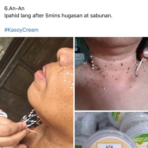 Kasoy Cream by Angel Touch skin tag keloid milia - Picture 2 of 9
